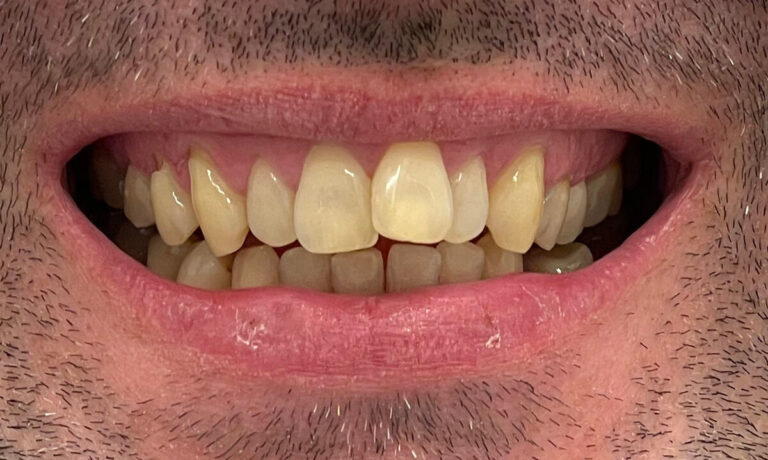 Metamorfoza II – invisalign - przed