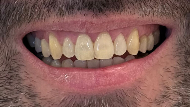 Metamorfoza II – invisalign - po