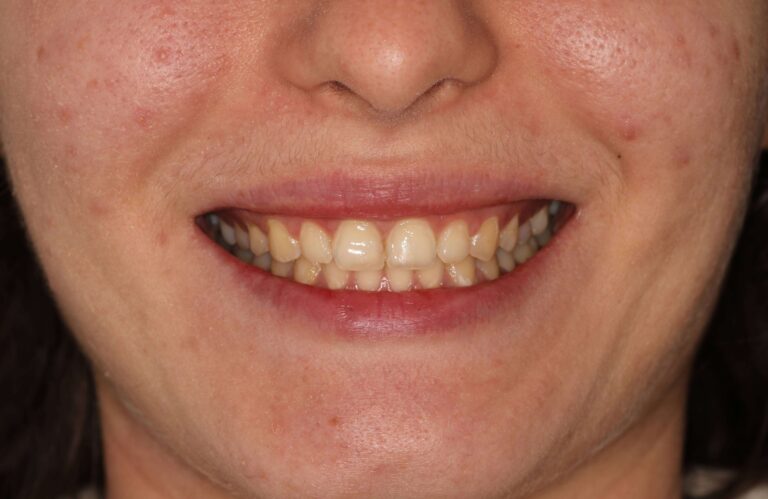 Metamorfoza I - przed